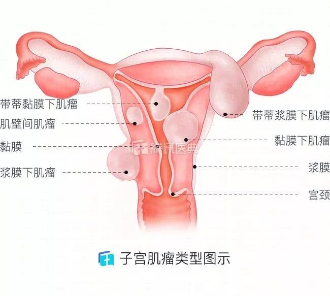 子宫简单长肌瘤的女性都有1个共性体检发现异常别粗心